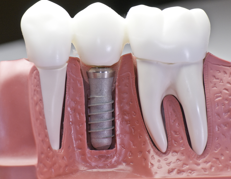dental implants Paramount CA